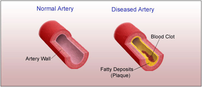 Signs You May Have Clogged Arteries, And How To Reverse It Naturally.